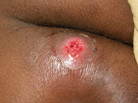 De la crème pour la protection contre les taches de pigment pour la personne
